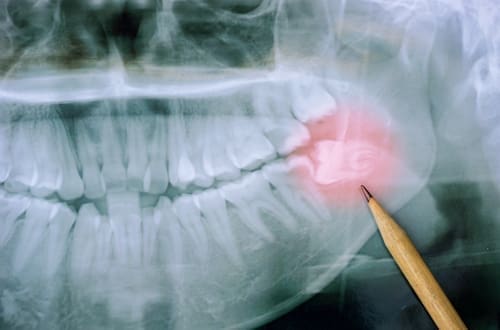 Wisdom Tooth Xray - Trade Winds Dental
